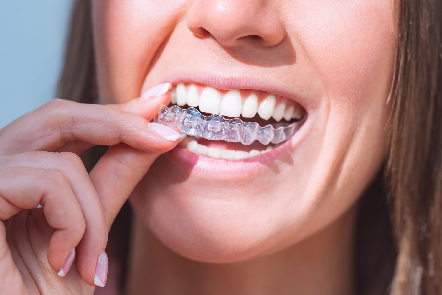 Invisalign Melbourne