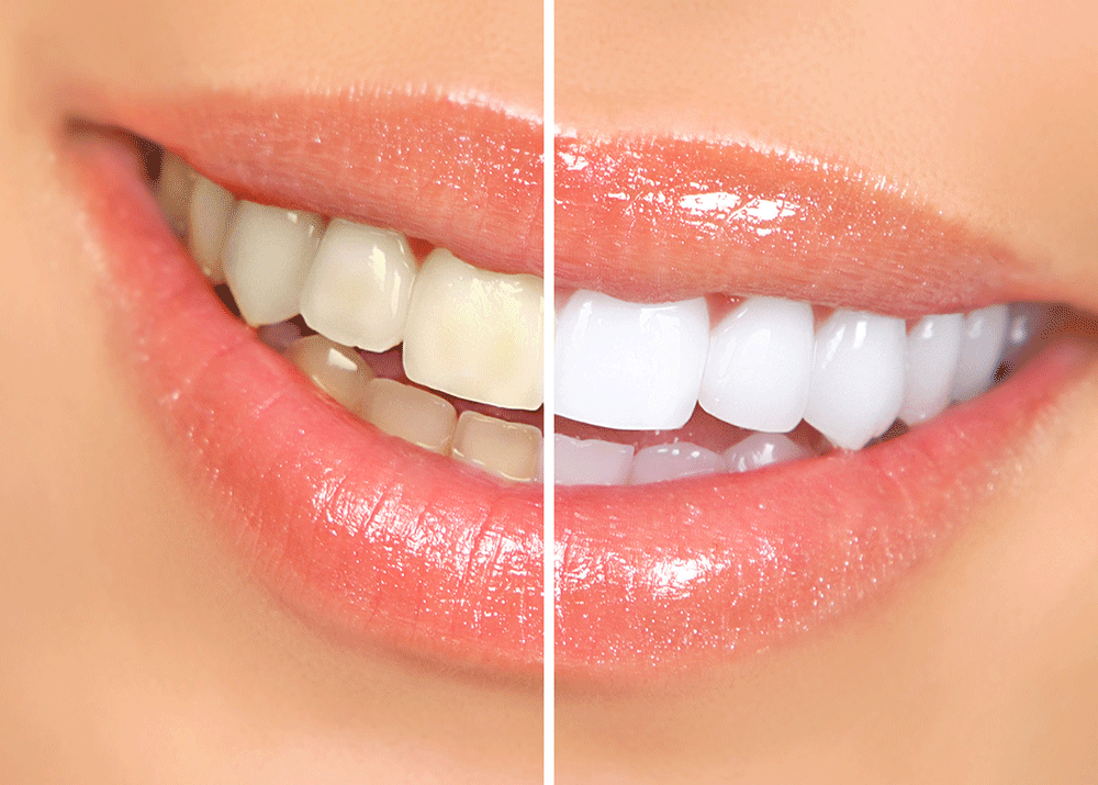 Teeth Whitening Melbourne