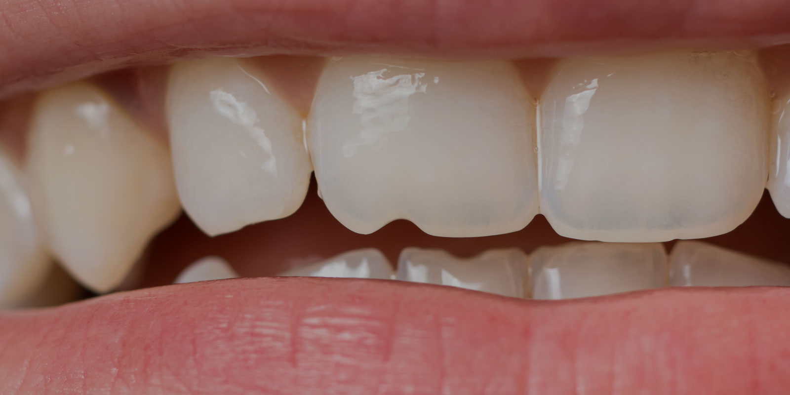 cracked or chipped tooth repair melbourne