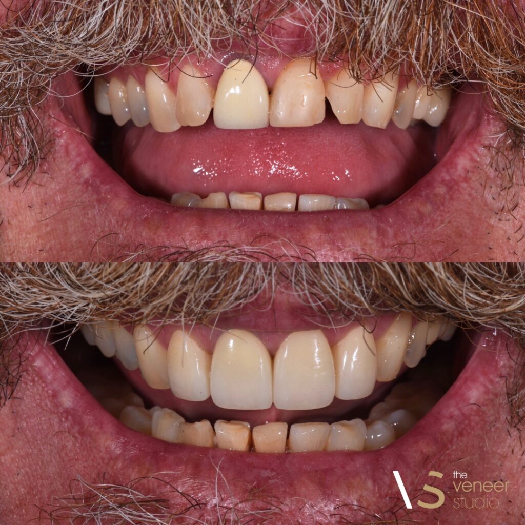 Cosmetic Veneers Melbourne