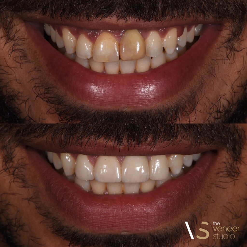 Dental Veneers