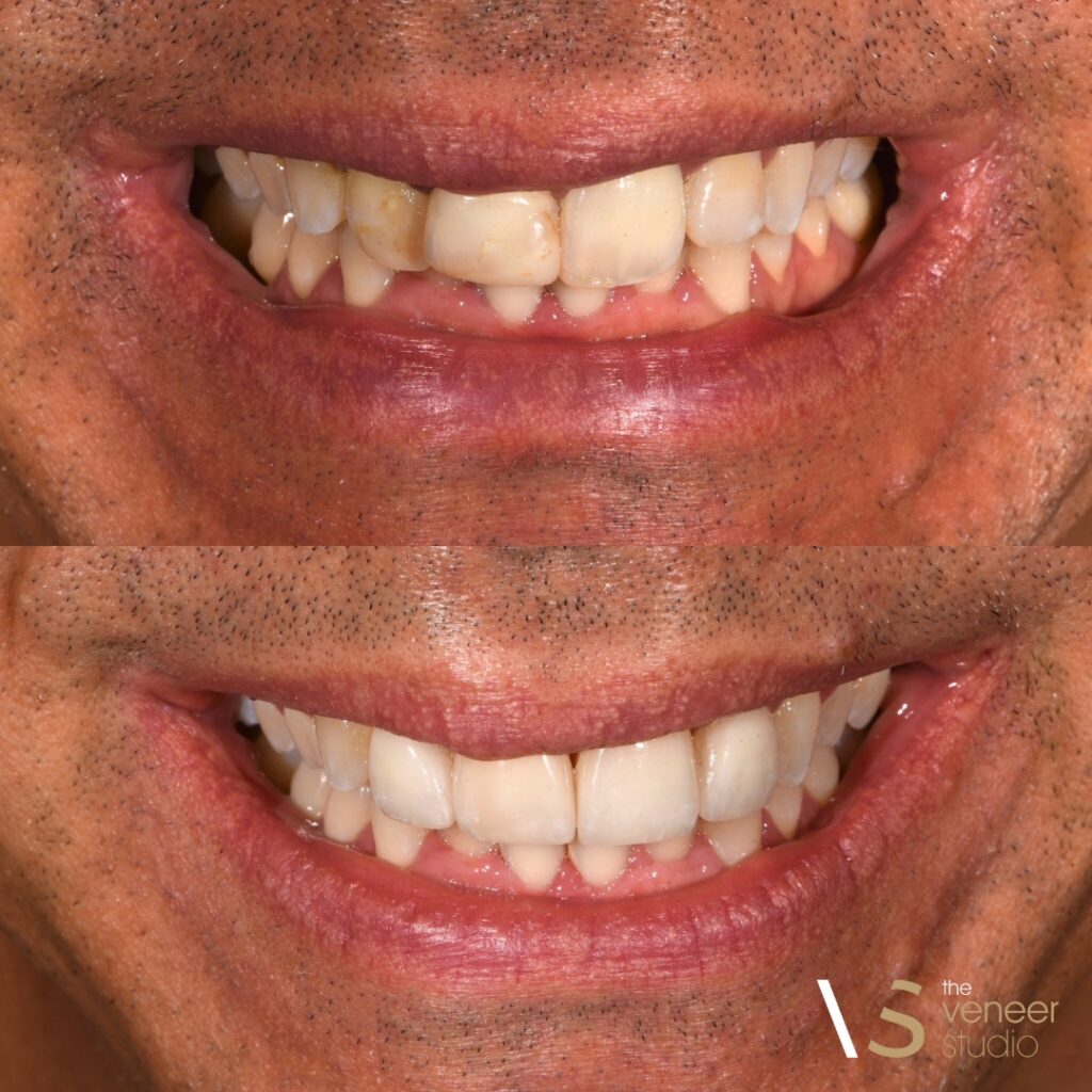 Dental Veneers Melbourne