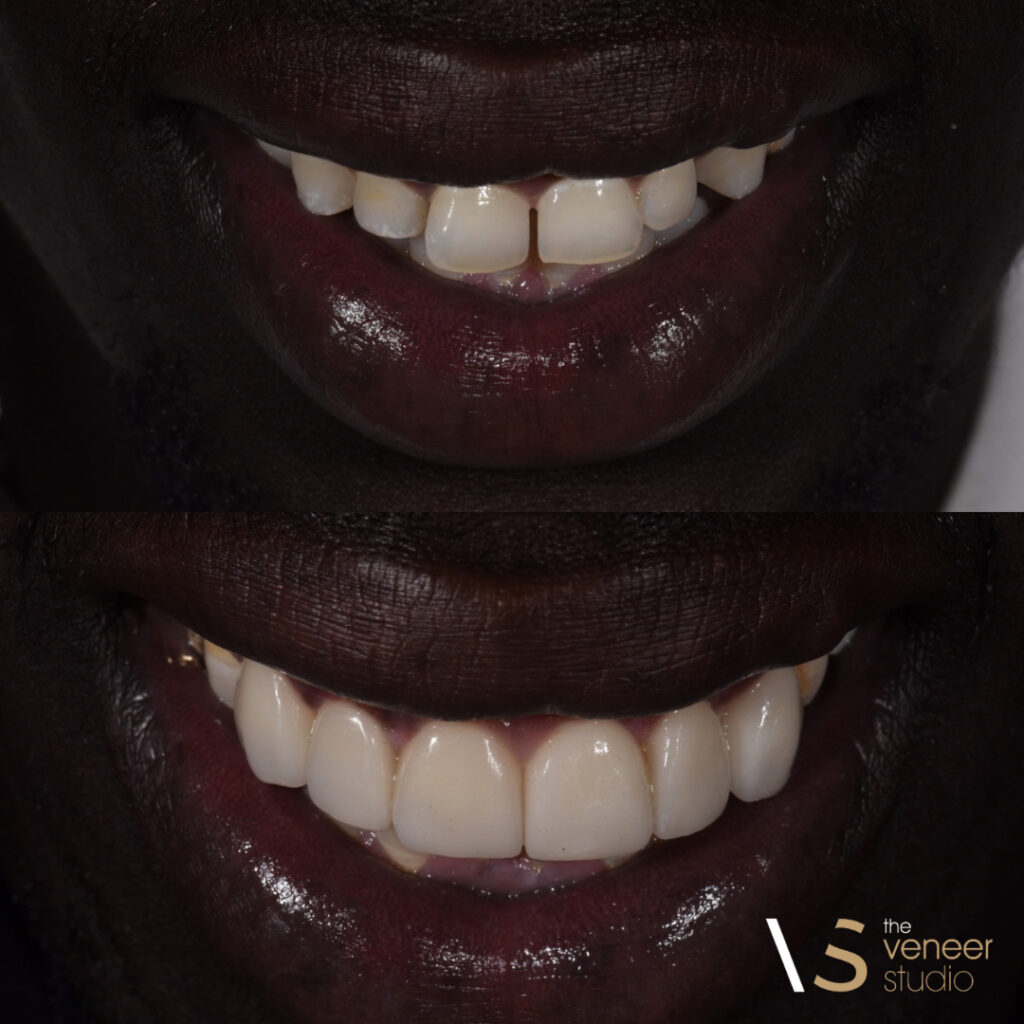 Porcelain Veneer
