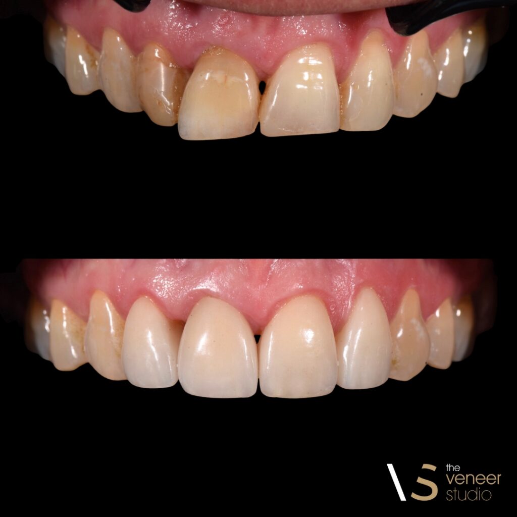 Porcelain Veneer Cosmetic Treatment
