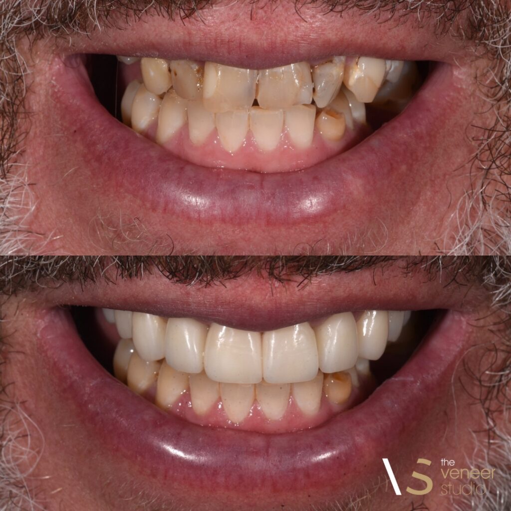 Porcelain Veneer Melbourne