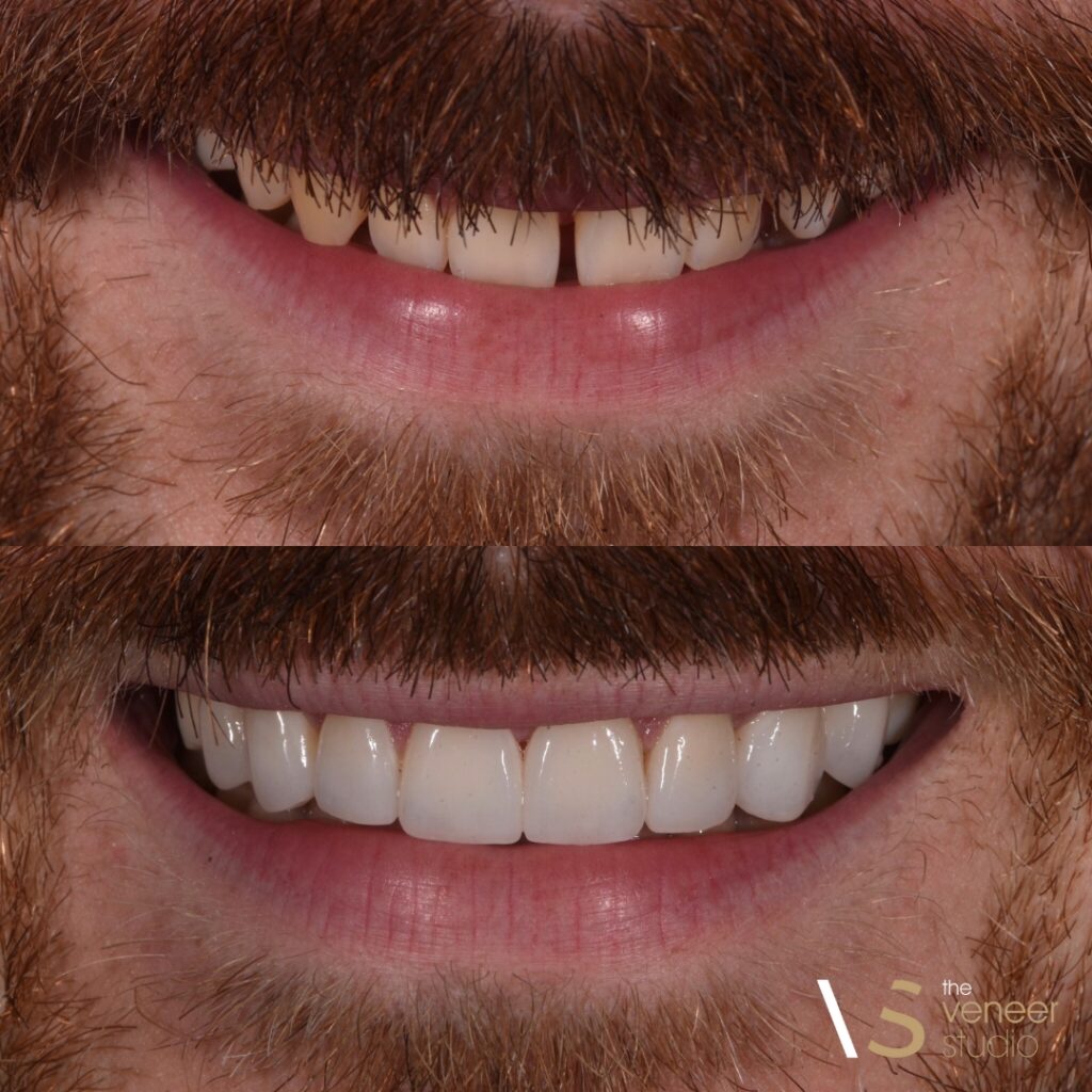 Porcelain Veneers
