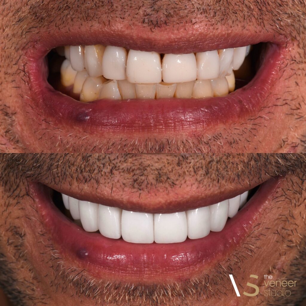 Porcelain Veneers Melbourne