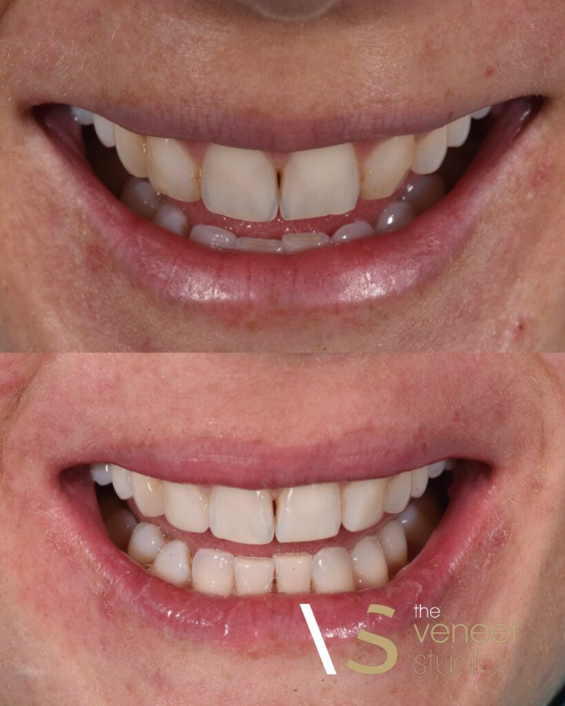 Composite Resin Veneers Melbourne