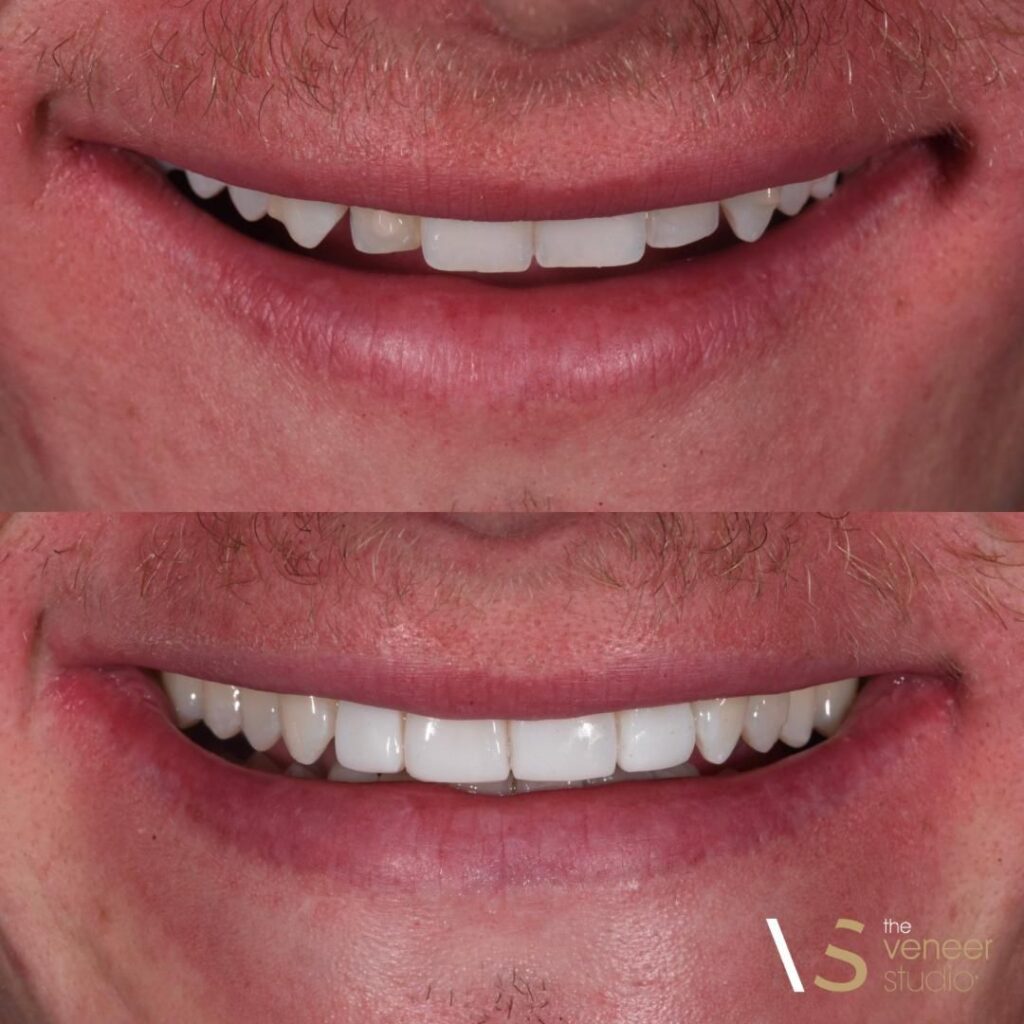 Composite Veneers Melbourne