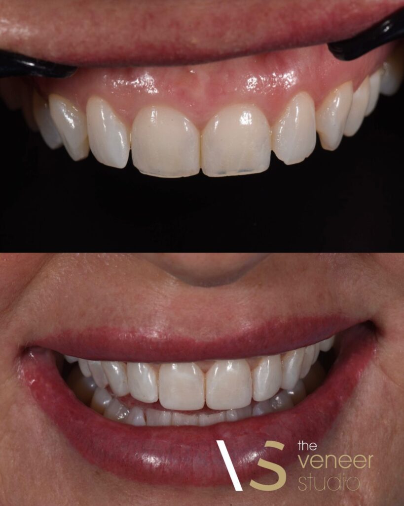 Composite Veneers in Melbourne