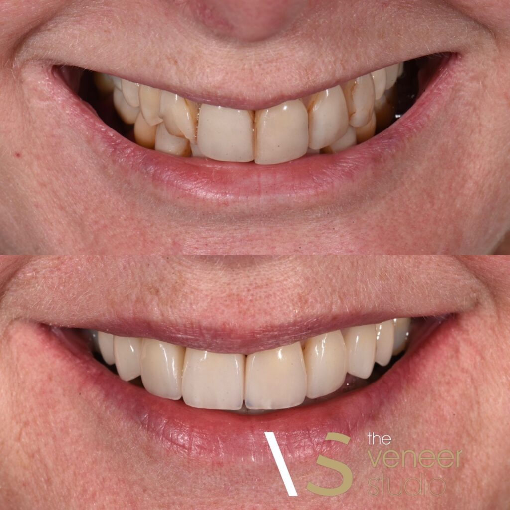 Before and After Porcelain Veneer Treatment
