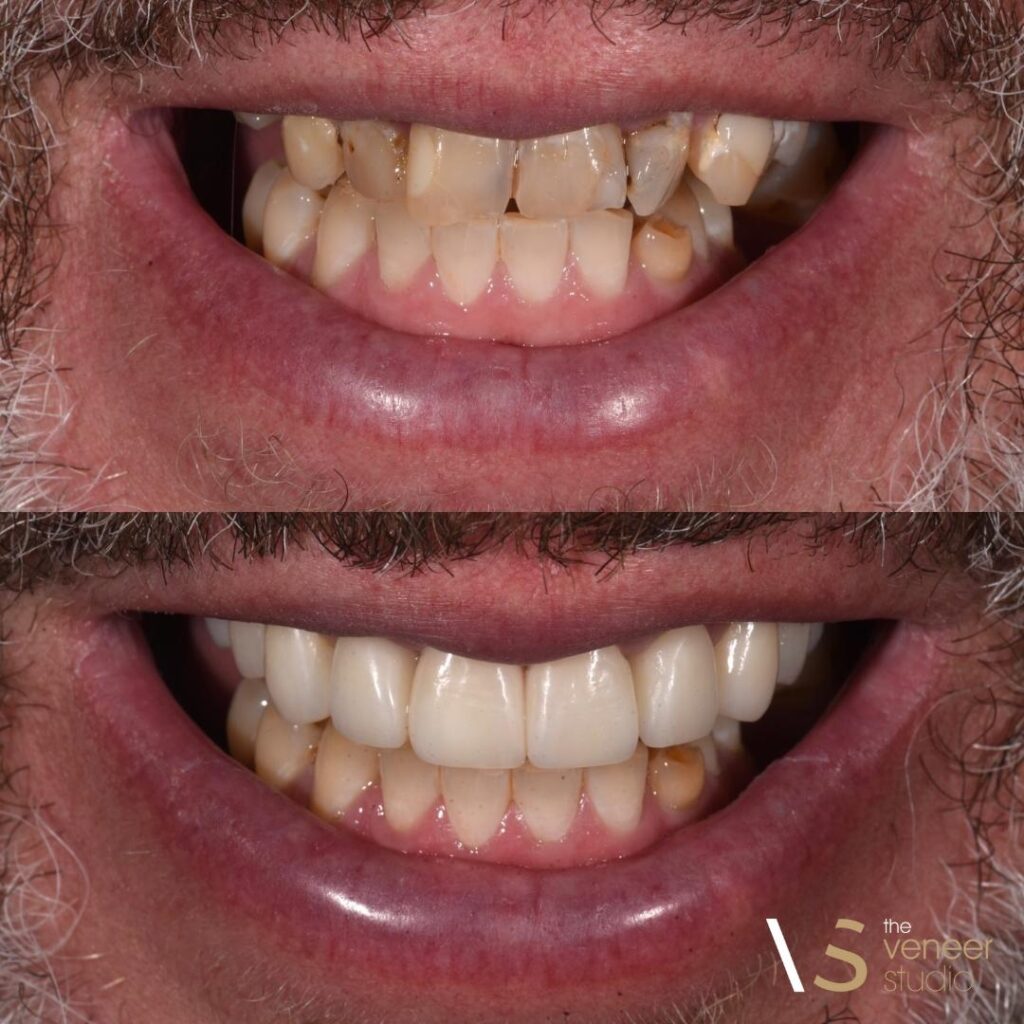 Dental Crown in Melbourne