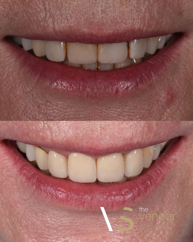 Porcelain Veneer Melbourne