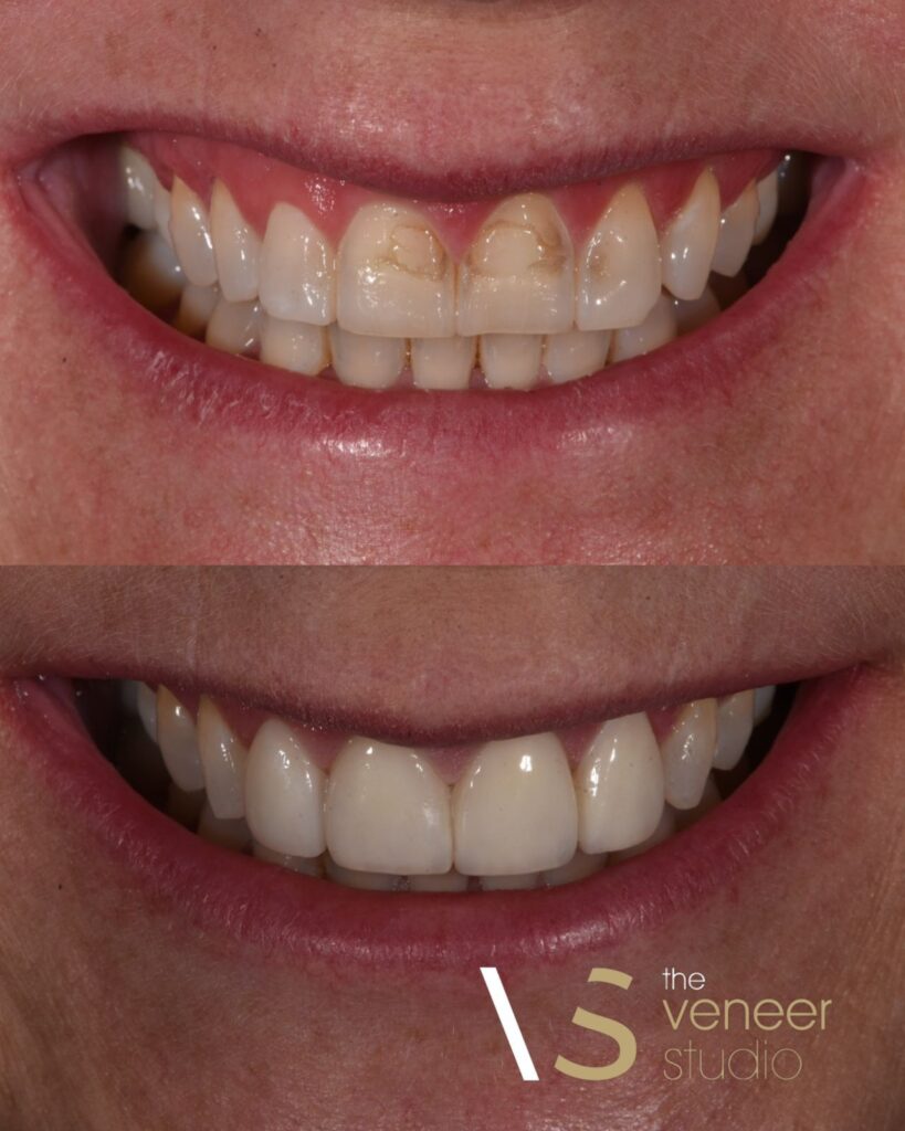 Porcelain Veneers Treatment Melbourne