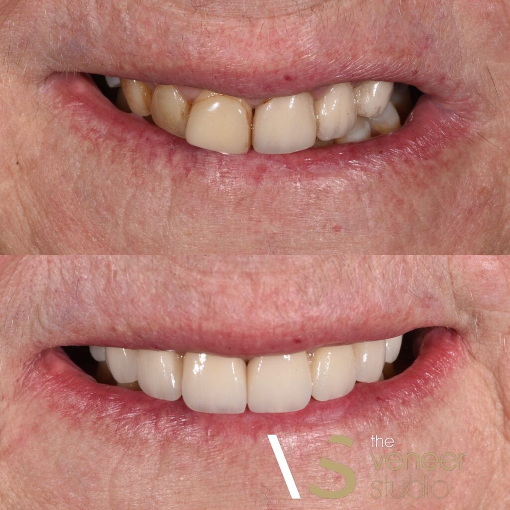 Smile Makeover with Porcelain Veneers