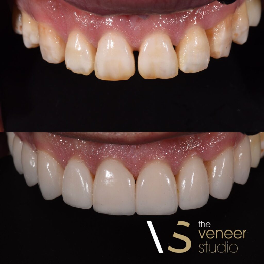 Treating Gaps with Porcelain Veneers