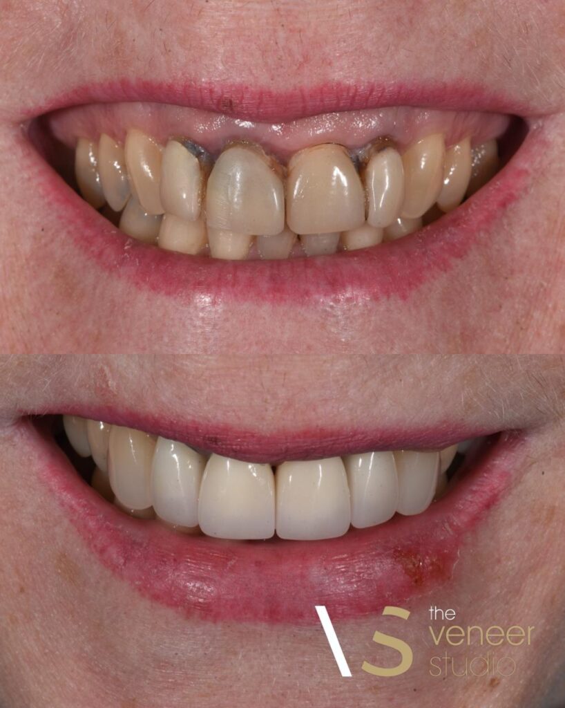 Dental Crown Treatment Melbourne