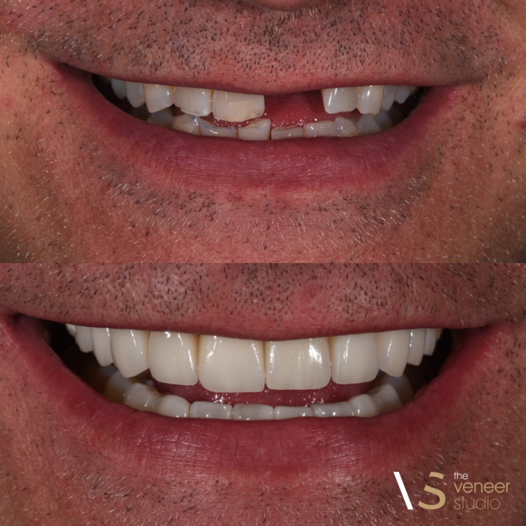 Porcelain Veneers Restoring a Smile