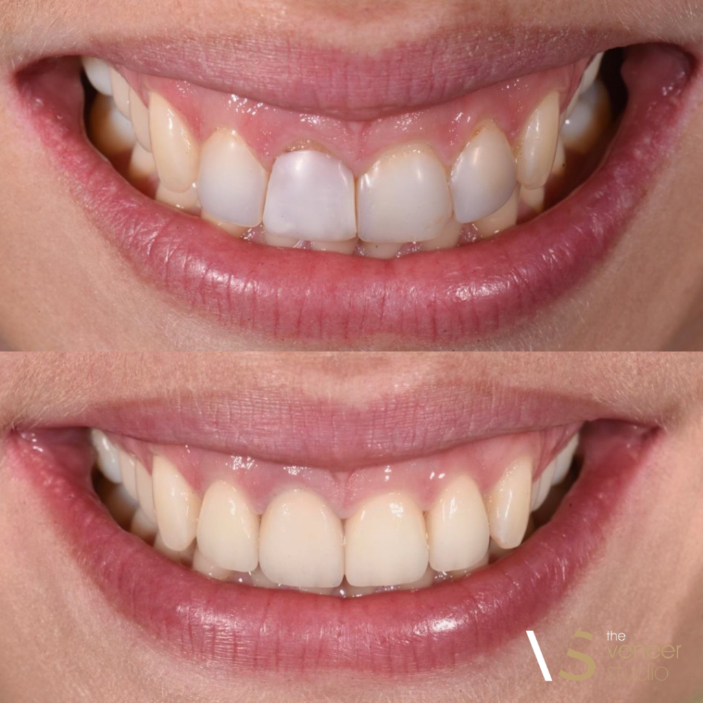 Smile Refinement with Composite Veneers and Gingival Contouring