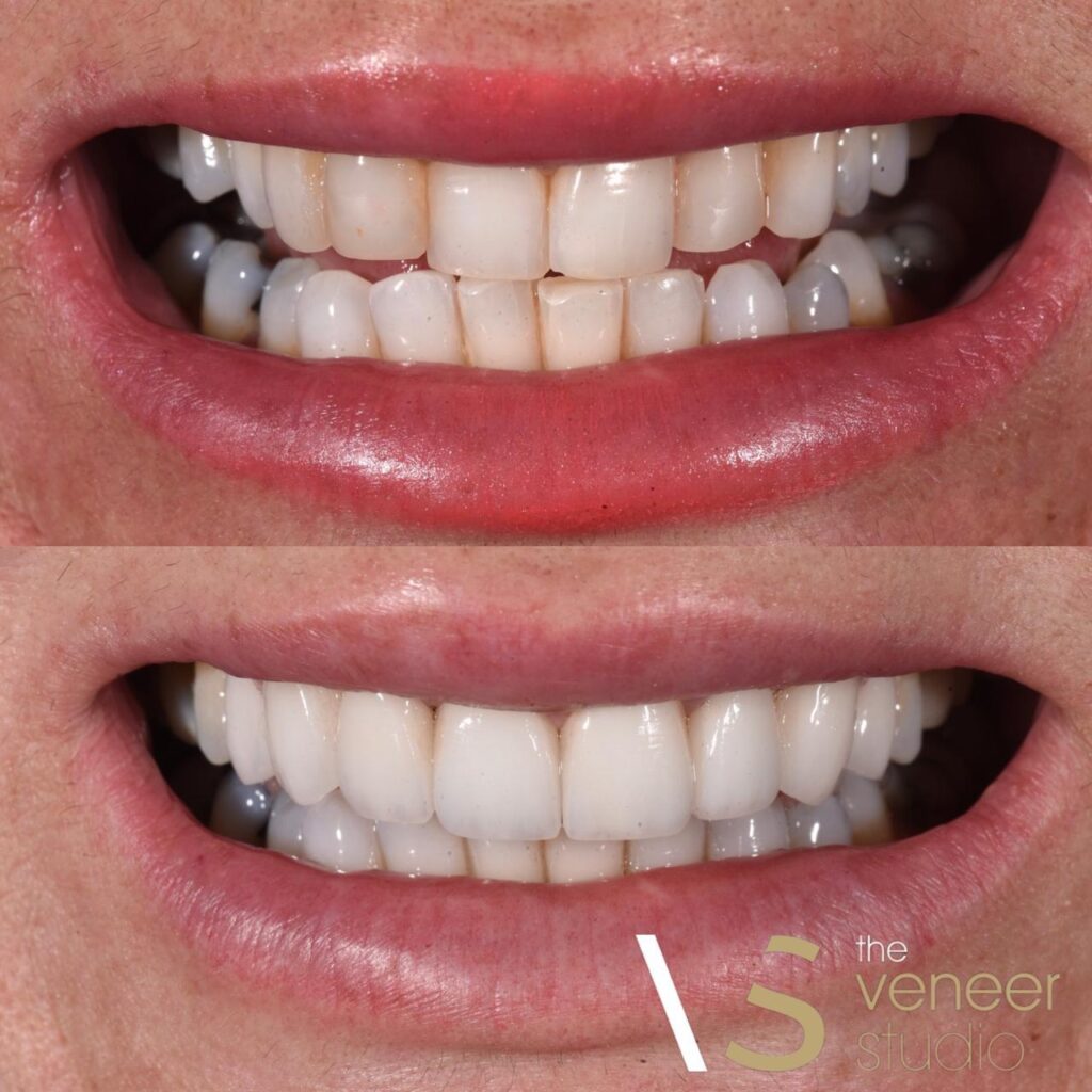 best porcelain veneers melbourne