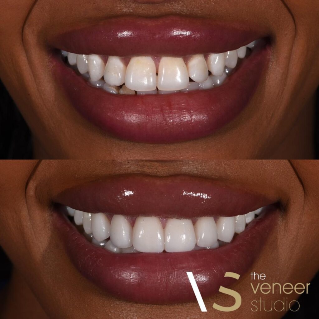 diastema closure with porcelain veneers
