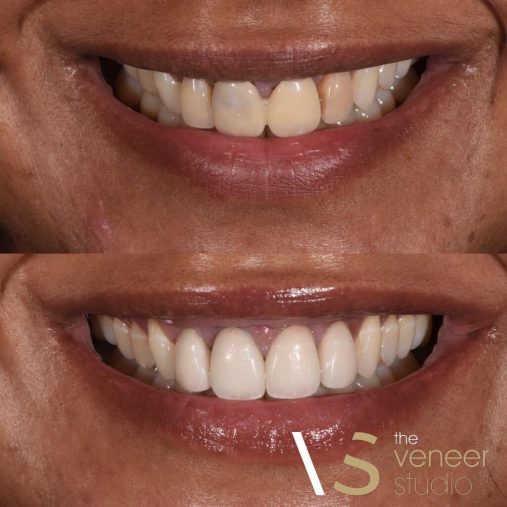 esthetic porcelain veneers