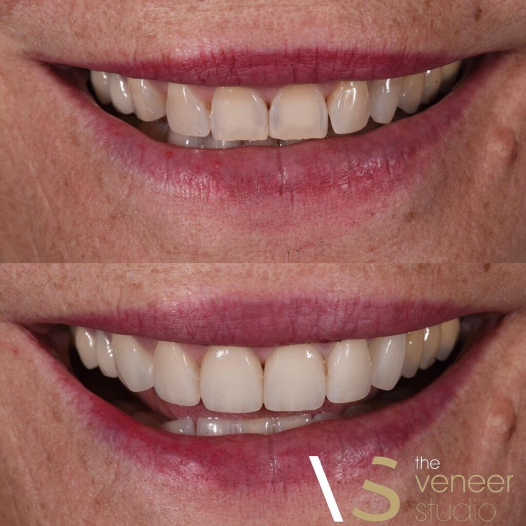 porcelain veneers