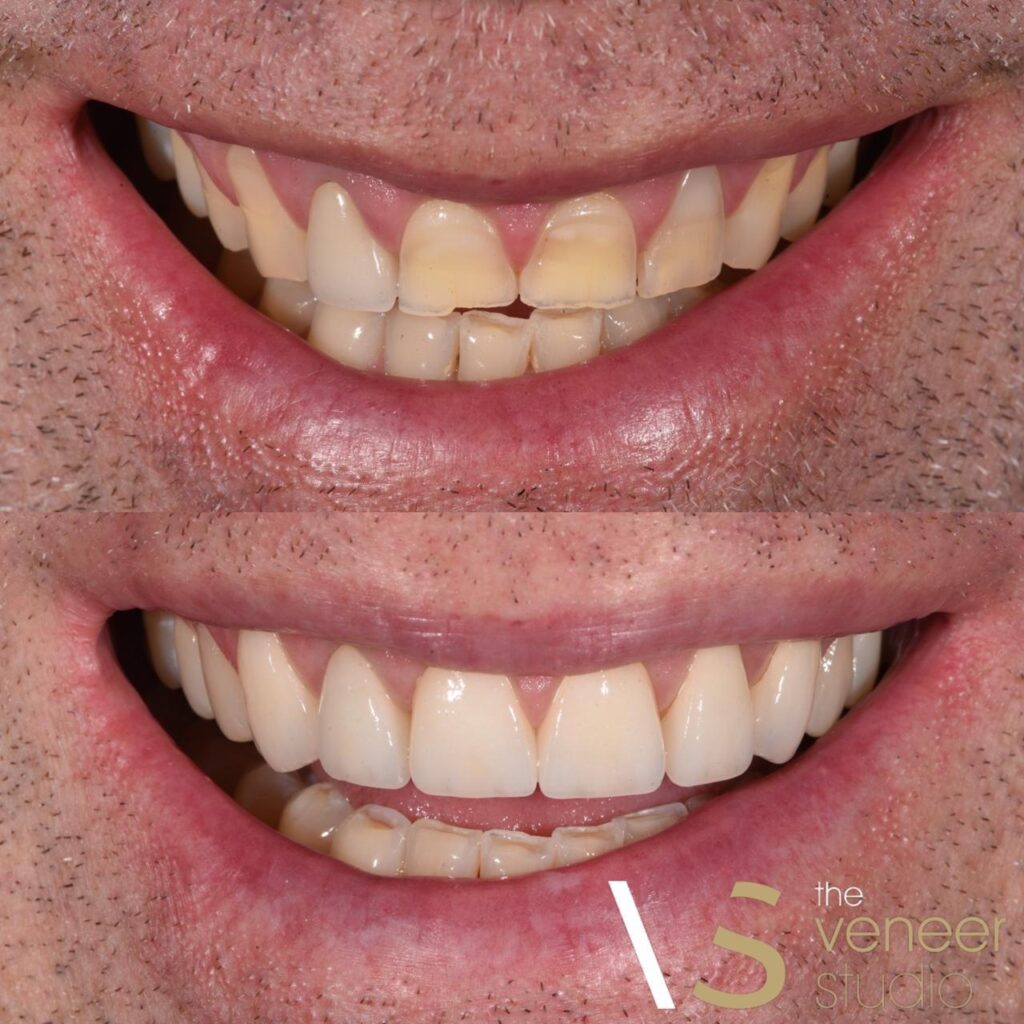 porcelain veneers covering intrinsic discolouration