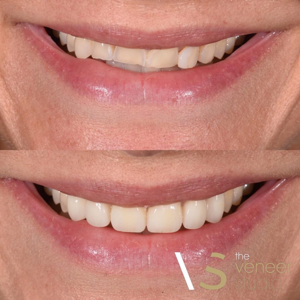porcelain veneers in melbourne