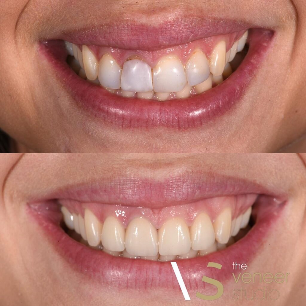 porcelain veneers melbourne