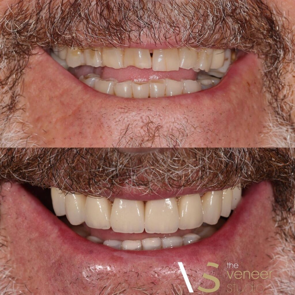 porcelain veneers melbourne patient
