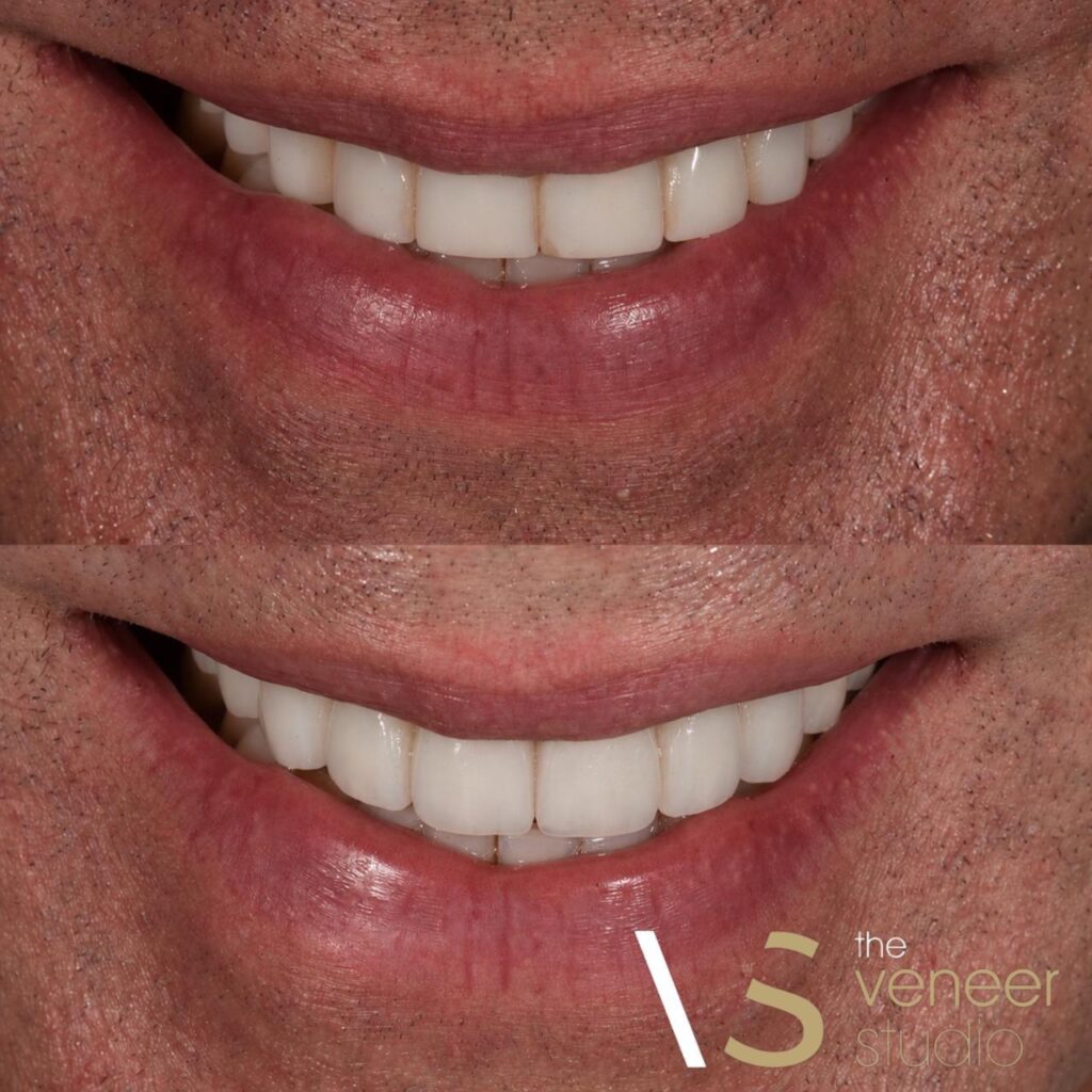 porcelain veneers smile