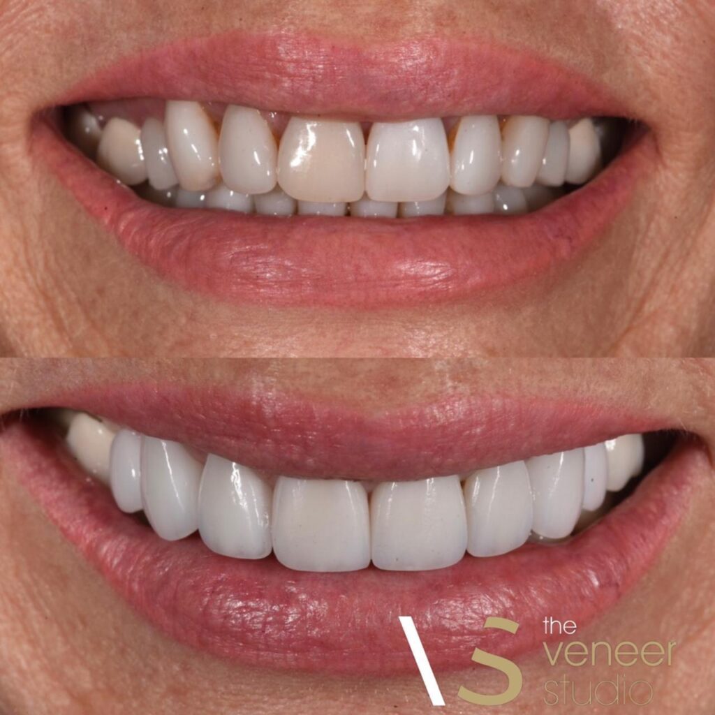 porcelain veneers smile