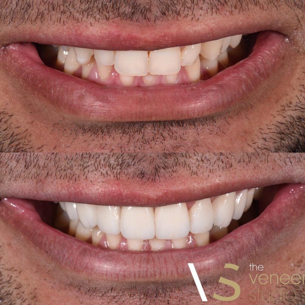 veneers melbourne